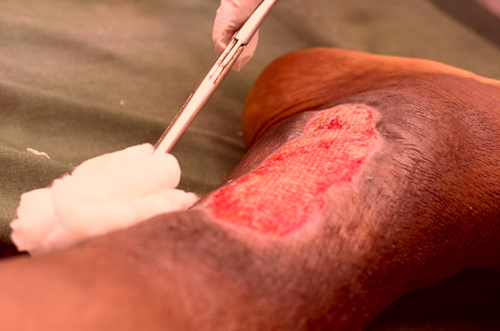 Leg ulcer wound treatment close-up